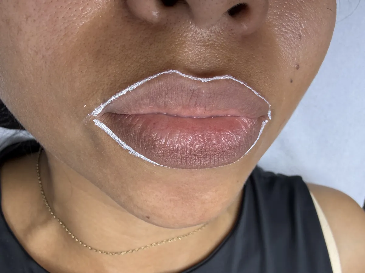 Labios con el diseño marcado antes del procedimiento